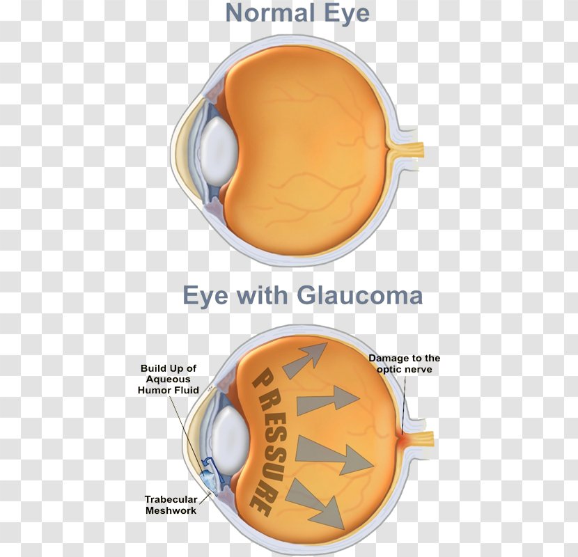 Glaucoma Human Eye Care Professional Optic Nerve Transparent PNG