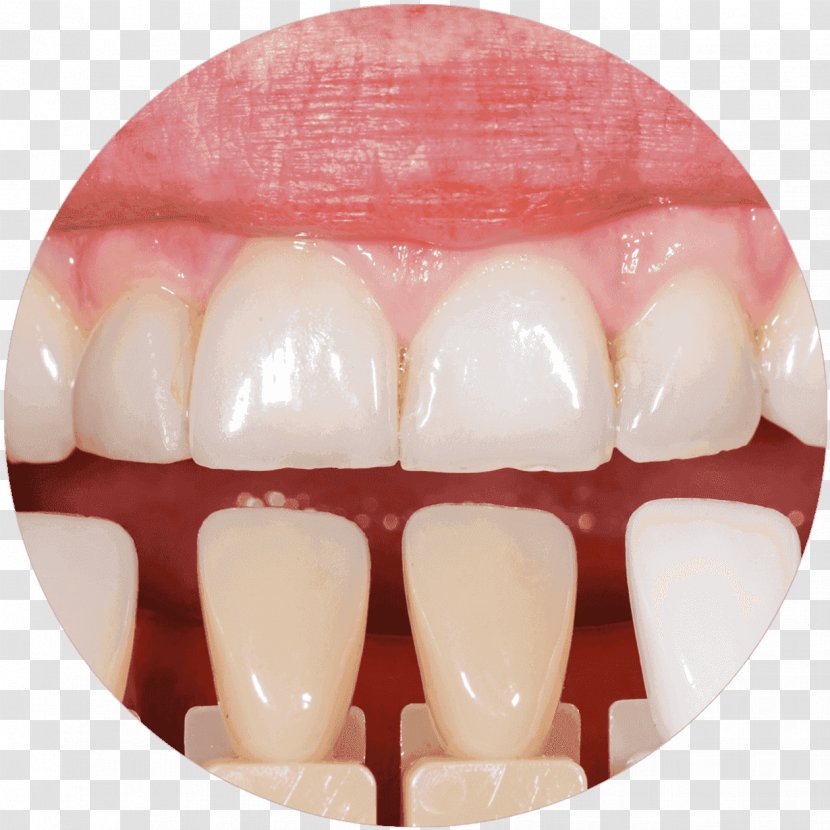 Tooth Whitening Cosmetic Dentistry Veneer - Dental Restoration - Crown Transparent PNG