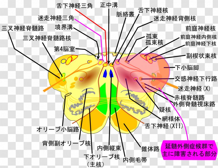 Lateral Medullary Syndrome Medulla Oblongata Posterior Inferior Cerebellar Artery Cerebellum - Cartoon - Tree Transparent PNG