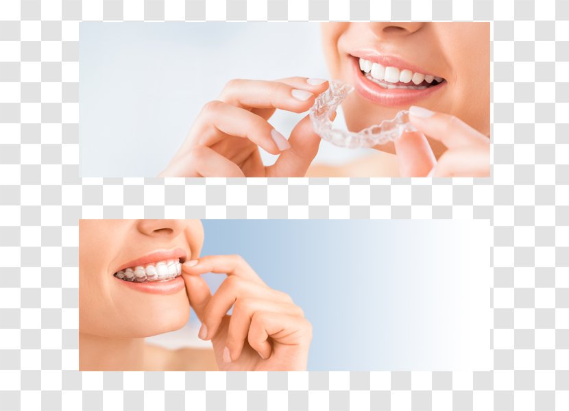 Clear Aligners Dentistry Orthodontics Dental Braces The Invisalign System - Close Up - Department Transparent PNG