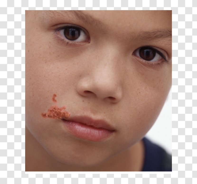 Impetigo Herpes Labialis Skin Infection Cutaneous Condition - Child - Dermatome Transparent PNG
