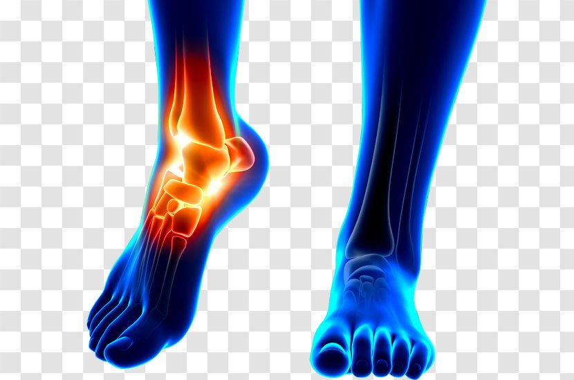 Orthopedic Surgery Sports Injury Ankle Replacement - Heart - Hallux Rigidus Transparent PNG