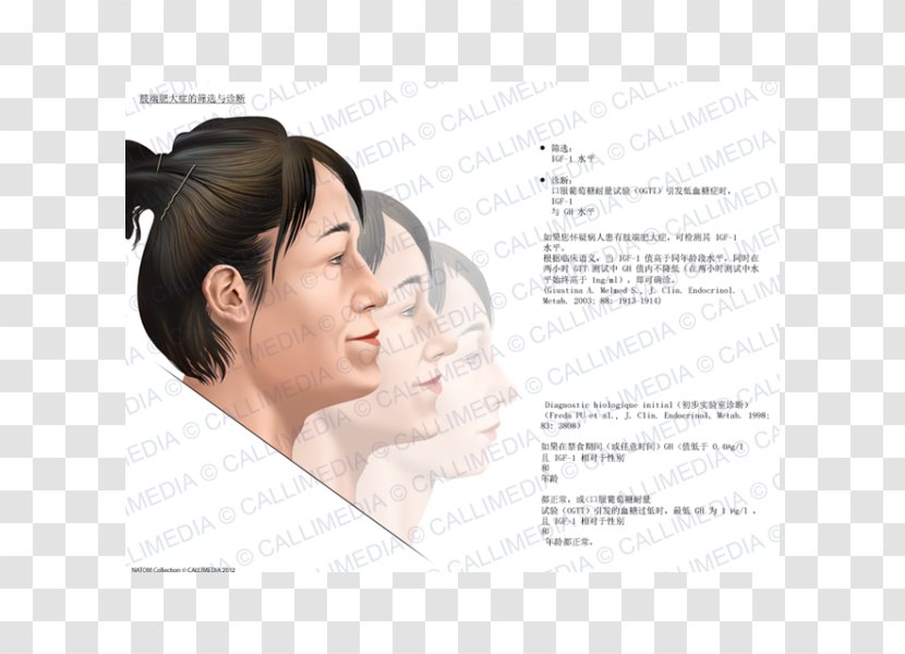 Acromegaly Diagnose Symptom Medical Diagnosis - Nose Transparent PNG