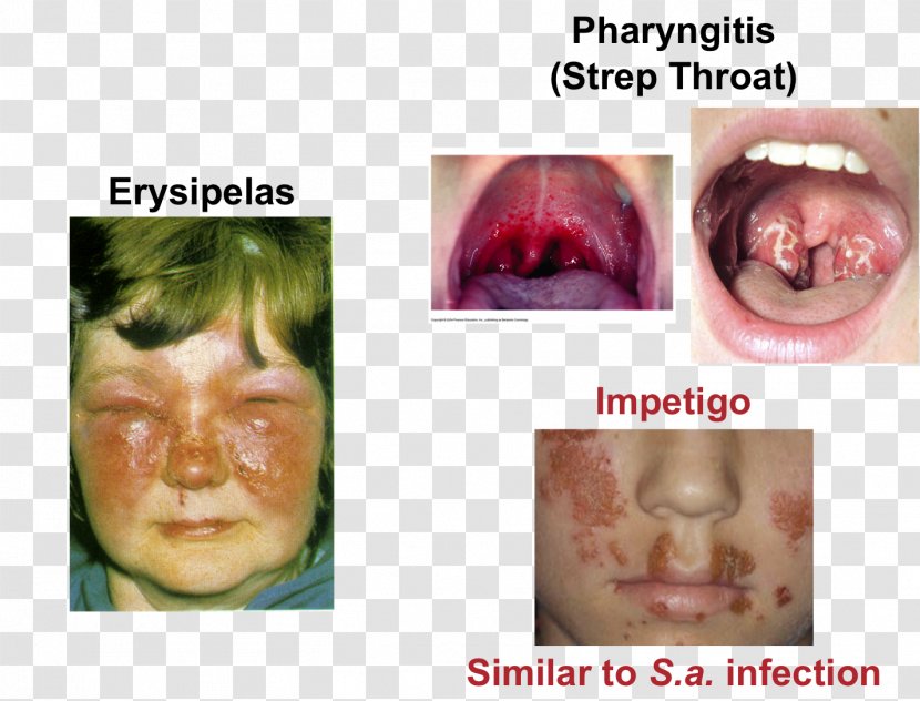 Lip Cheek Streptococcal Pharyngitis Chin Tonsillitis - Nose Transparent PNG