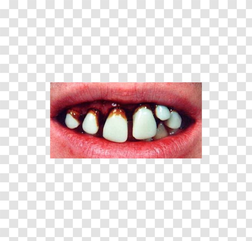 Human Tooth Dentures EBay Hillbilly - Mouth - DENTIST MASK Transparent PNG