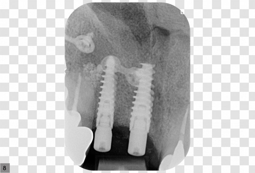 Dental Implant Jaw Soft Tissue Radiography - X Ray - Implants Transparent PNG