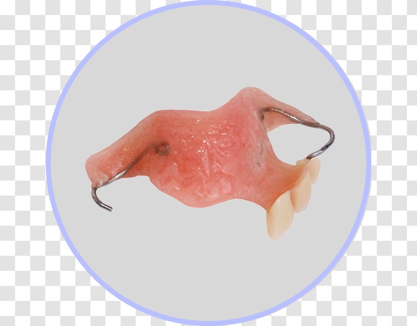 Durant Dentures Removable Partial Denture Human Tooth Dentistry - Dental Implant - Flippers Transparent PNG