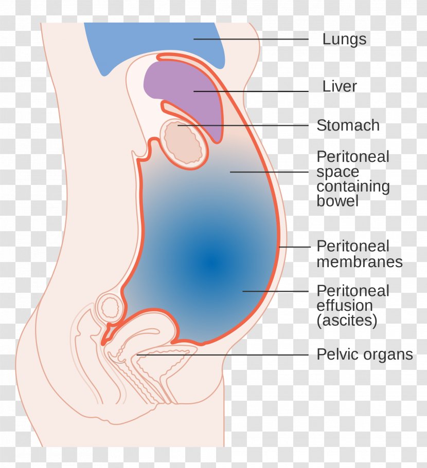 Hepatomegaly Symptom Liver Ascites Medical Sign - Heart - Cartoon Transparent PNG