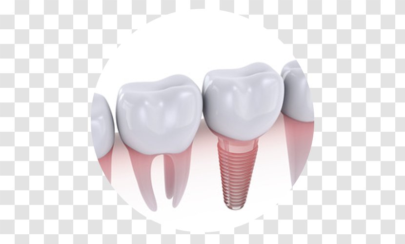 Dental Implant Dentistry Dentures Crown - Silhouette Transparent PNG