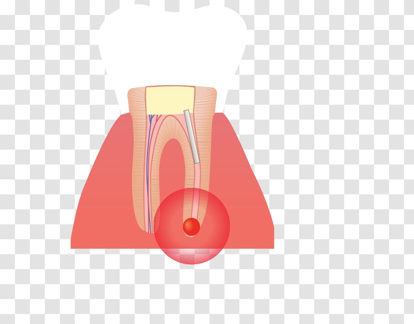 Root Canal Infection Tooth Poster Transparent PNG