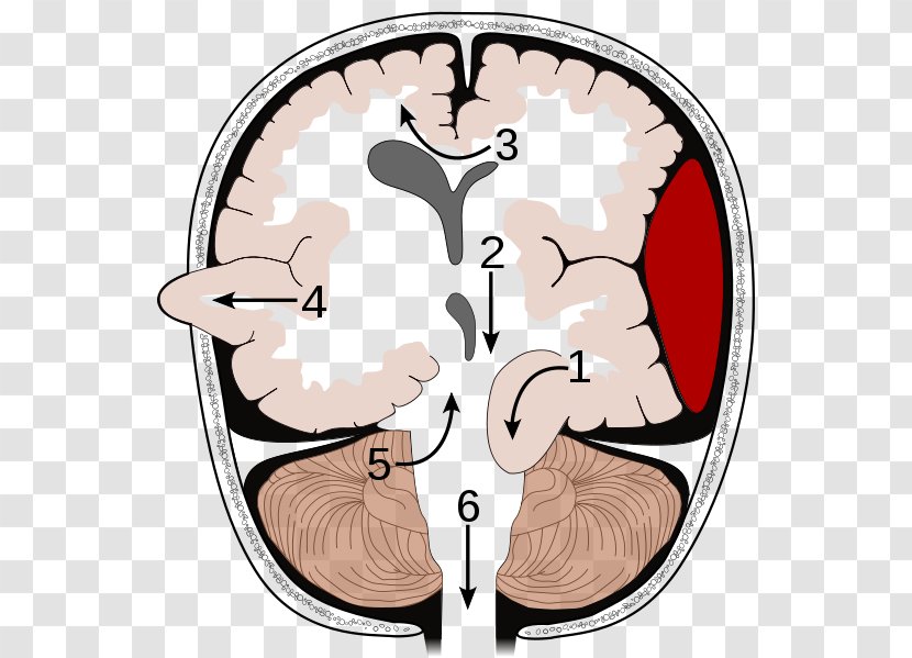 Brain Herniation Intracranial Pressure Traumatic Injury Cerebellar Tentorium - Silhouette - Hole Burr Transparent PNG