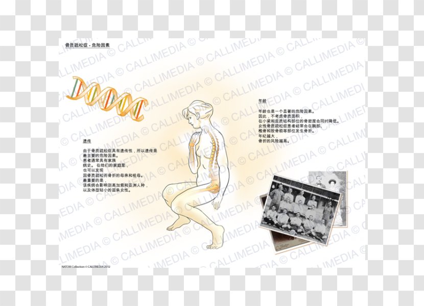 Osteoporosis Risk Factor Rheumatology Osteopenia - Thyroid Disease Transparent PNG