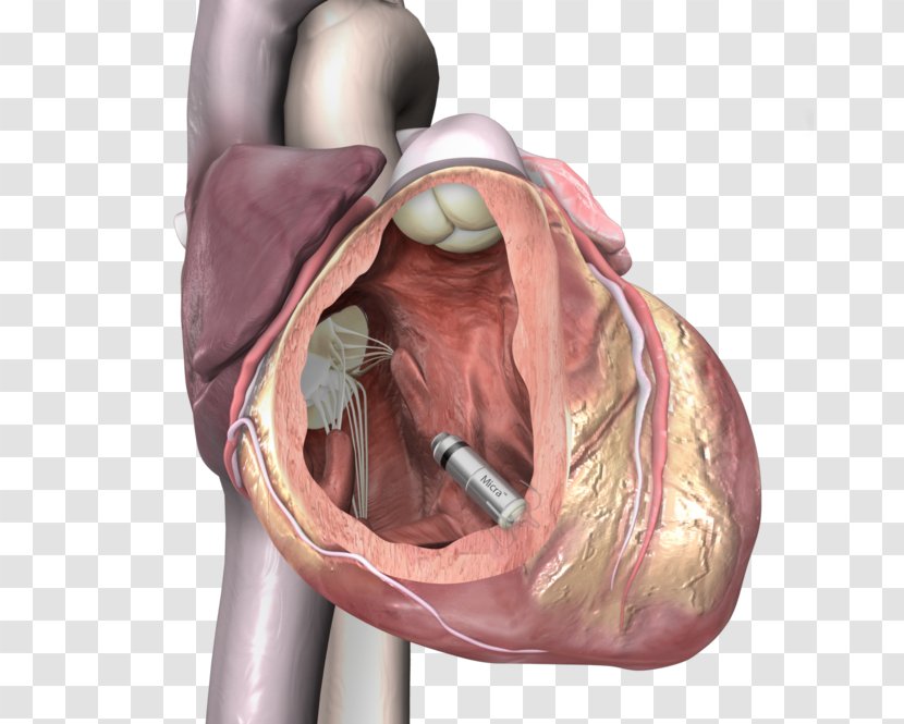Artificial Cardiac Pacemaker Medtronic Implantable Cardioverter-defibrillator Cardiology - Watercolor - Heart Transparent PNG