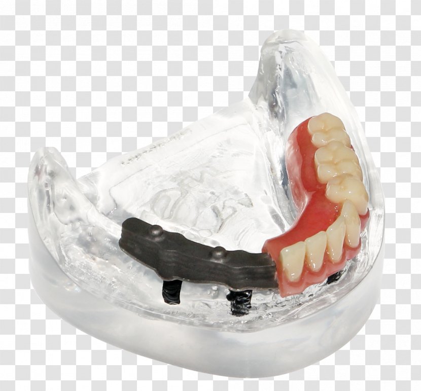 Dentures Prosthesis Tooth Bar Dentistry - Titanium Transparent PNG