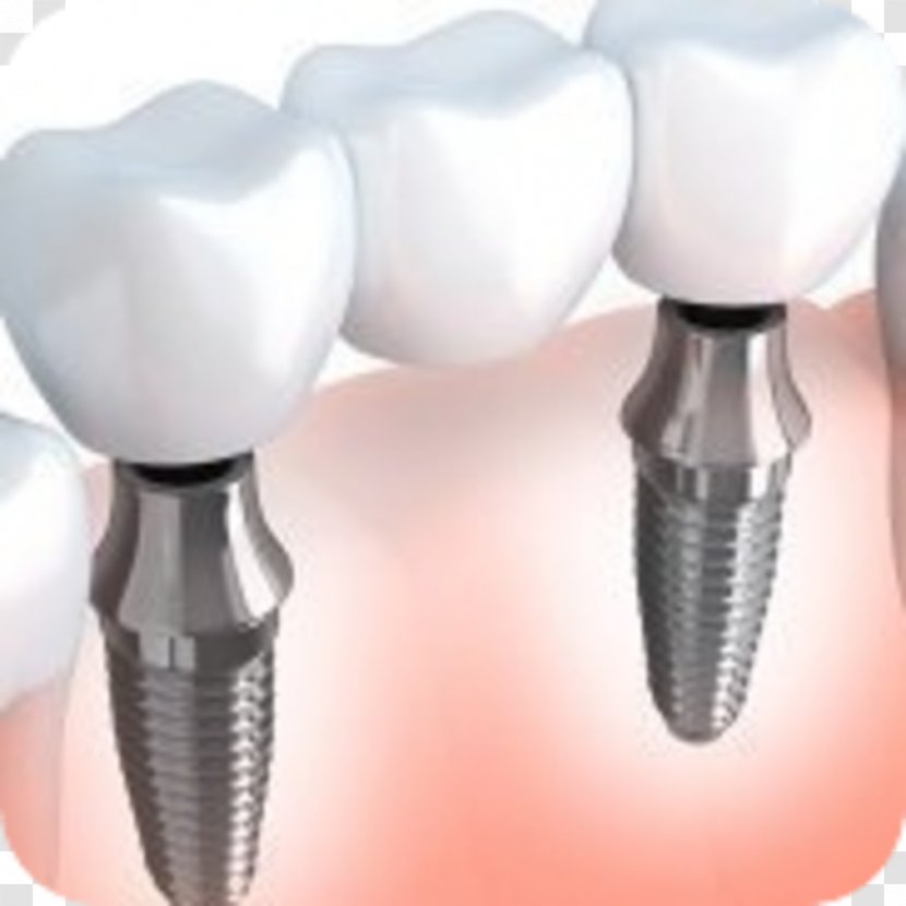 Dental Implant Bridge Dentistry Dentures - Human Tooth - Implants Transparent PNG