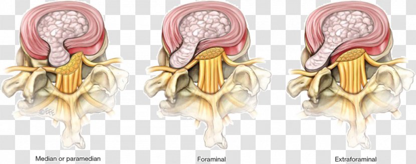 Lumbar Disc Herniation Spinal Surgery Disease Discectomy - Heart - Tree Transparent PNG
