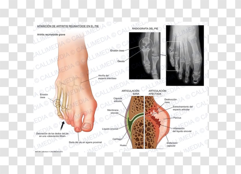 Rheumatoid Arthritis Foot Thumb Rheumatology - Silhouette - Frame Transparent PNG