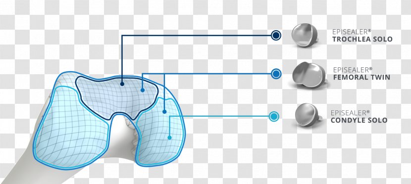 Knee Replacement Implant Joint Cartilage - Tree - Implants Transparent PNG