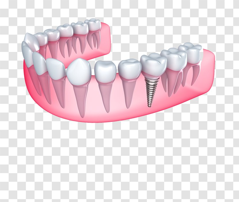 Dental Implant Cosmetic Dentistry Bridge - Mouth Transparent PNG