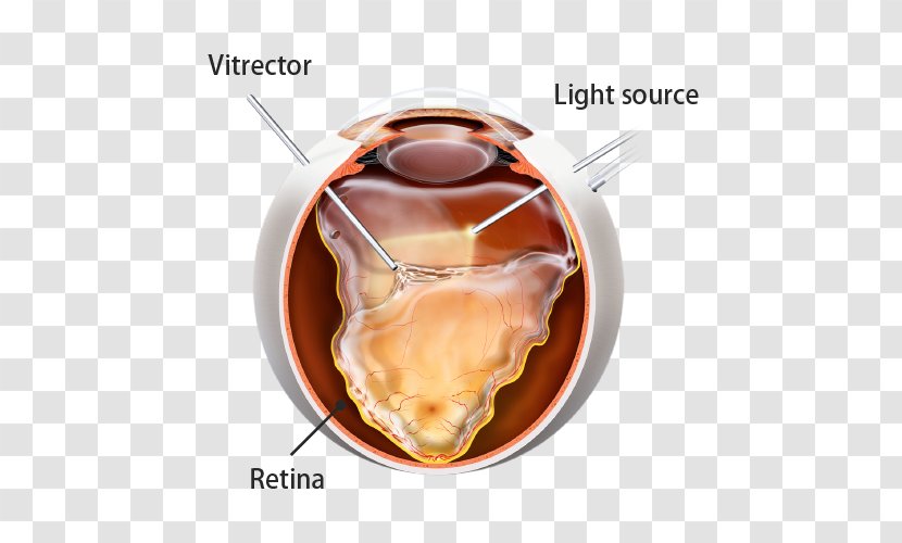 Retinal Detachment Vitrectomy Surgery Eye - Flavor Transparent PNG