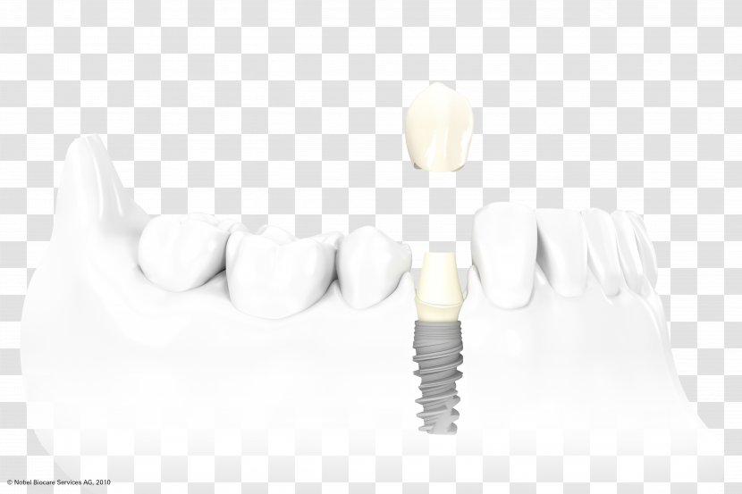 Dental Implant Dentistry Surgery Crown Transparent PNG