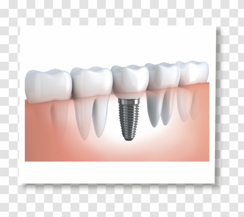 Dental Implant Dentistry Dentures - Cartoon - Crown Transparent PNG