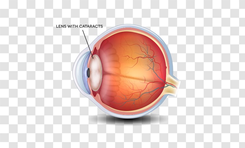 Cataract Surgery Ophthalmology Lens Eye Care Professional Transparent PNG