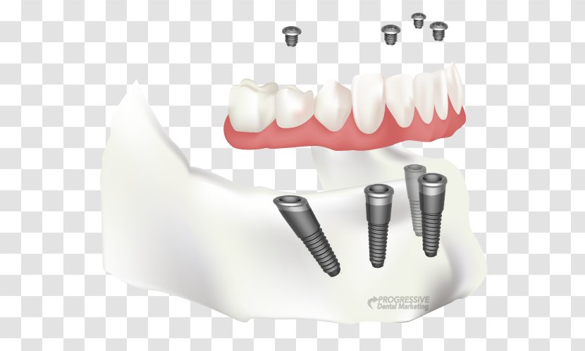Tooth Dental Implant Dentistry All-on-4 - Jaw - Permanent Teeth Transparent PNG