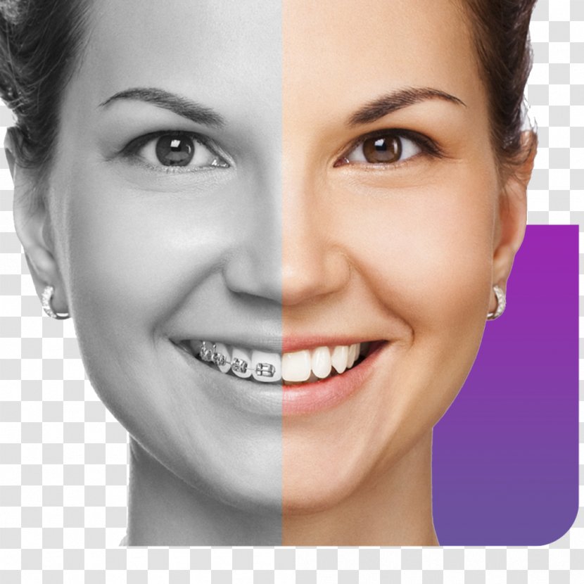 Элайнер Smile Dental Braces Tooth Jaw Transparent PNG