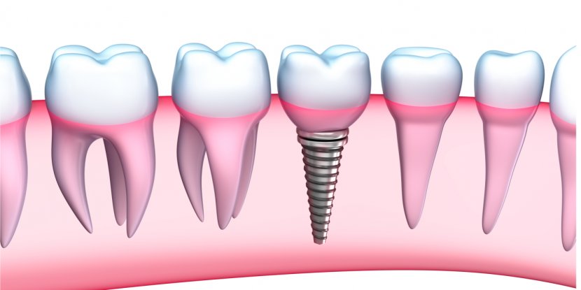 Dental Implant Dentistry Human Tooth Dentures - Frame - Teeth Transparent PNG