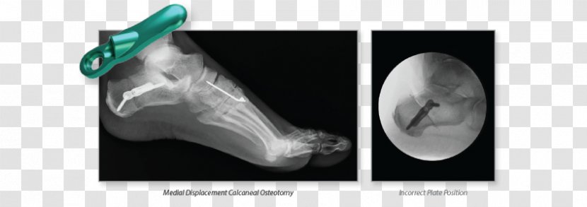 Osteotomy Calcaneus Bone Joint Wright Medical Group - Radiology - Foot Closeup Transparent PNG