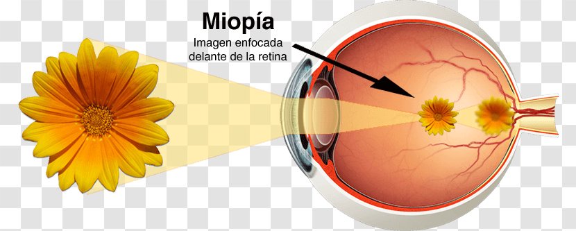 Human Eye Astigmatism Near-sightedness Far-sightedness - Symptom - Miopia Transparent PNG