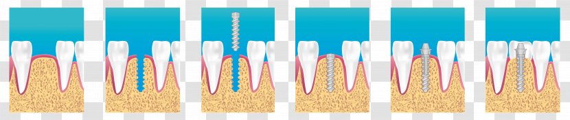 Dental Implant Dentistry Surgery Bridge - Tooth - Implants Transparent PNG
