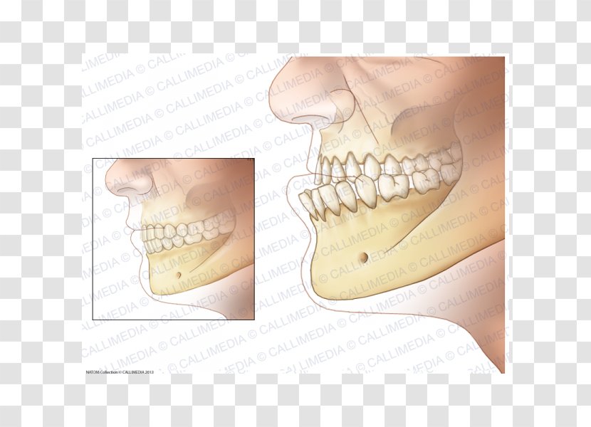 Acromegaly Prognathism Jaw Endocrinology Growth Hormone Transparent PNG