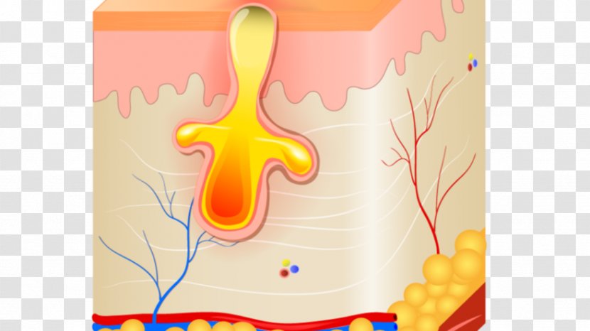Sebaceous Gland Poil Inflammation Acne Comedo - Rendez Vous Transparent PNG