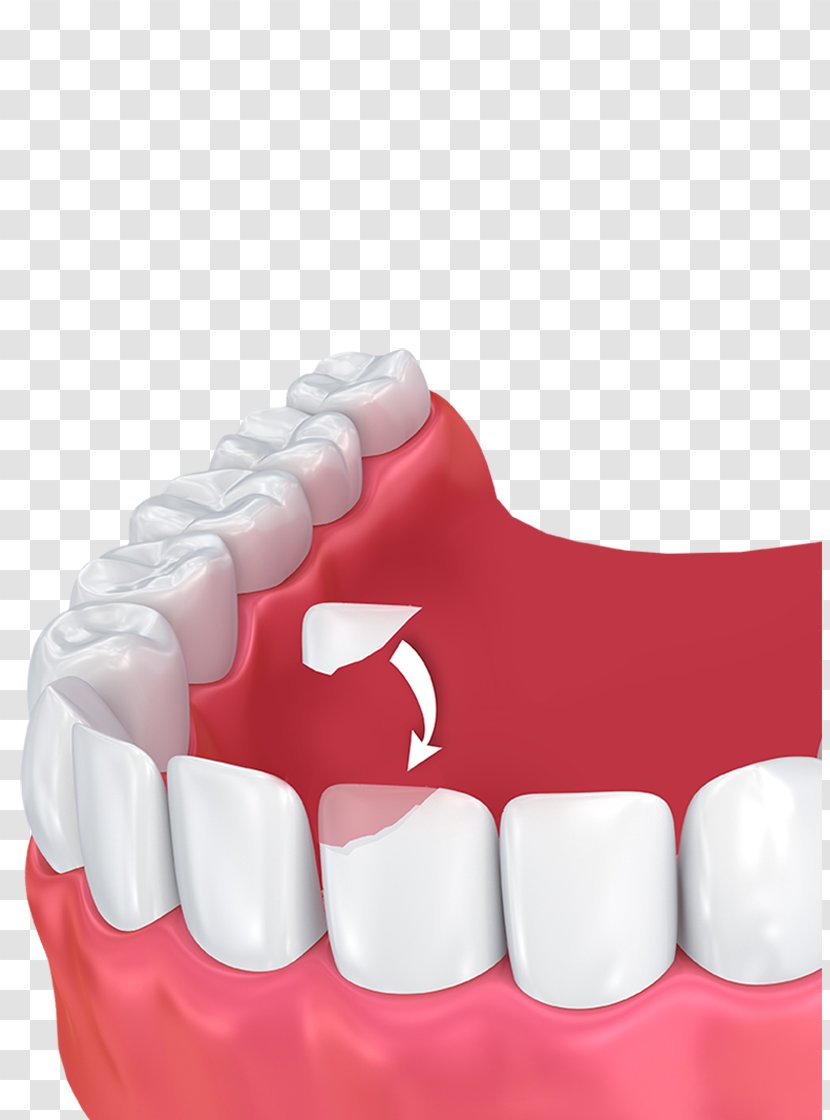 Human Tooth Dental Bonding Cosmetic Dentistry - Watercolor - Rail Transparent PNG