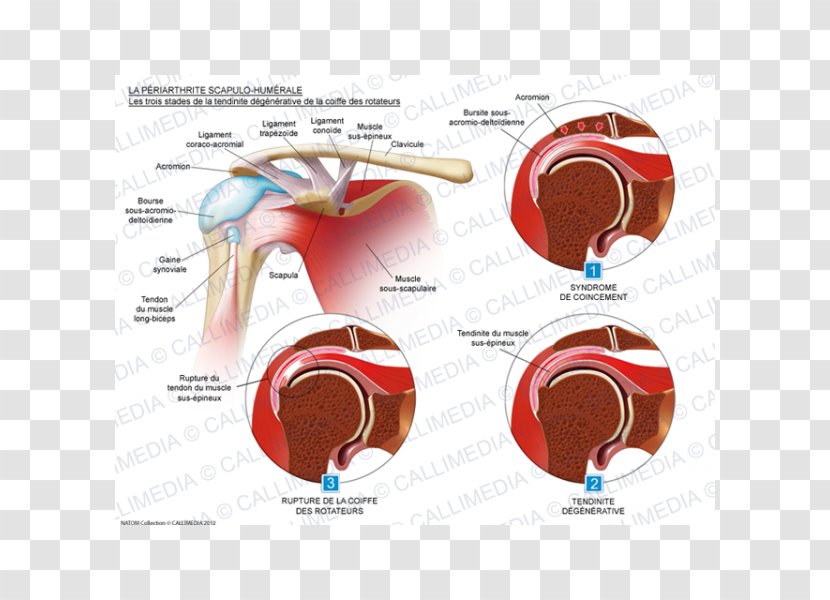 Rotator Cuff Tear Tendinitis Tendinopathy Tendon - Heart - Degenerate Transparent PNG