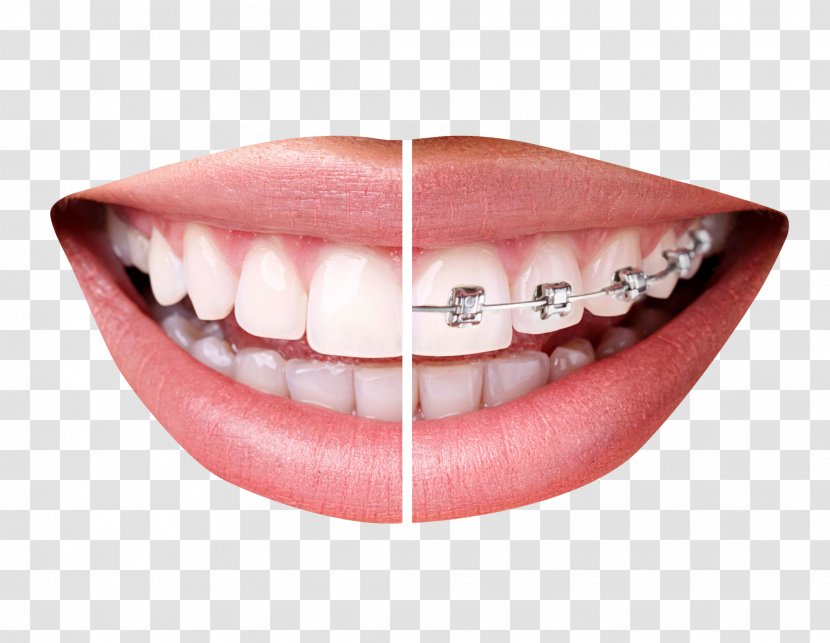 Dental Braces Clear Aligners Orthodontics Tooth Dentistry - Jaw - Teeth With Transparent PNG