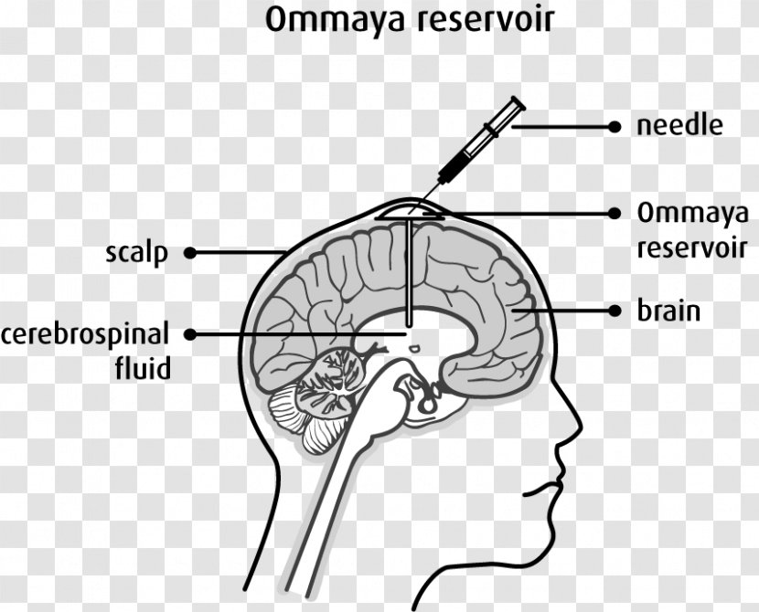 Ommaya Reservoir Intrathecal Administration Chemotherapy Cancer Brain Tumor - Heart - Silhouette Transparent PNG