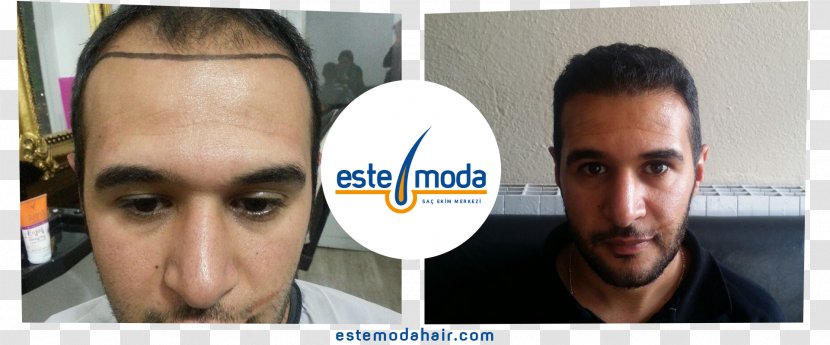 Este Moda Hair Saç Ekim Merkezi Transplantation Eyebrow Capelli - Adana Transparent PNG