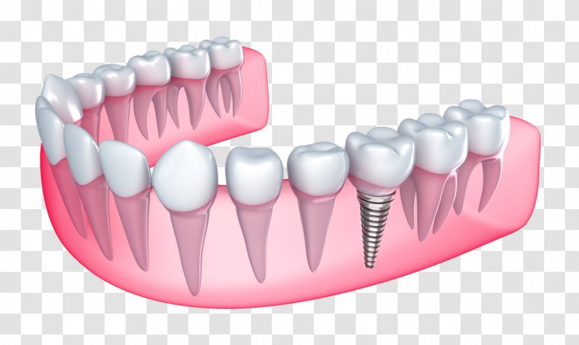 Dental Implant Dentistry Tooth Loss - Bridge Transparent PNG