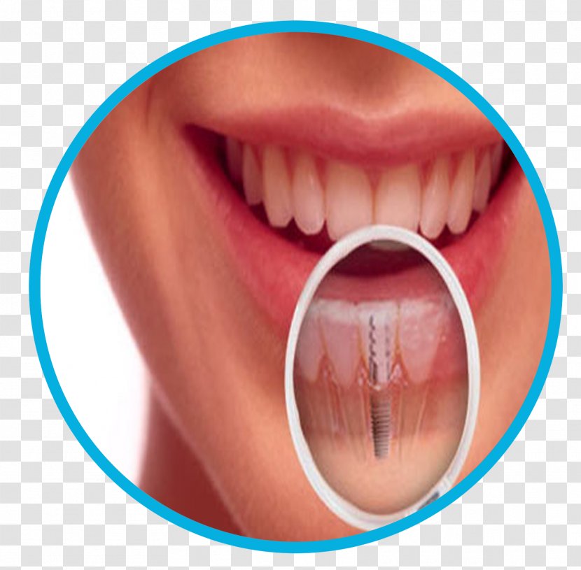 Dentistry Dental Implant Tooth - Nail Transparent PNG