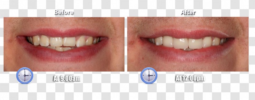 Tooth Close-up - Cosmetic Dentistry - Befor After Transparent PNG