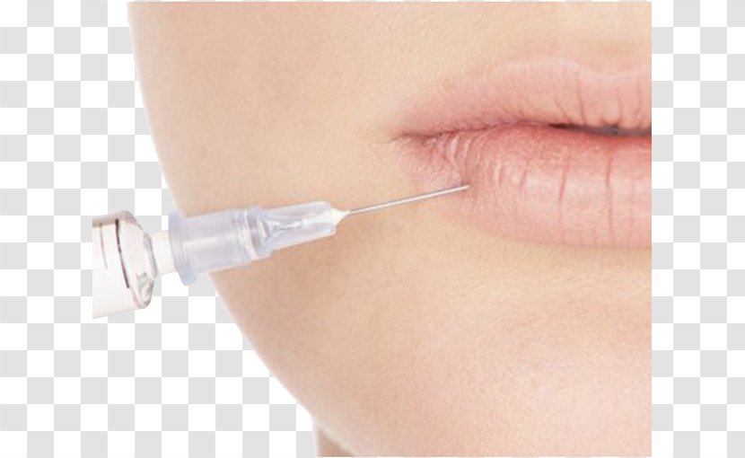 Skin Hyaluronic Acid Reconstructive Surgery Woman Injection - Health - Playing Transparent PNG
