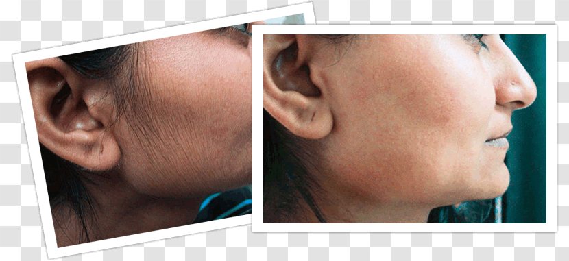 Hair Removal Facial Woman - Face - Before And After Transparent PNG