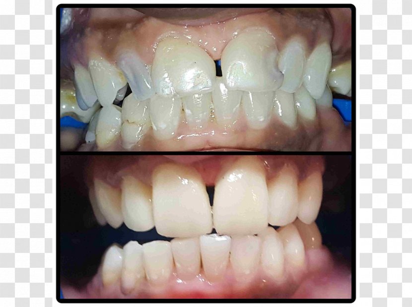 Tooth Veneer Dental Implant Dentist Crown Transparent PNG
