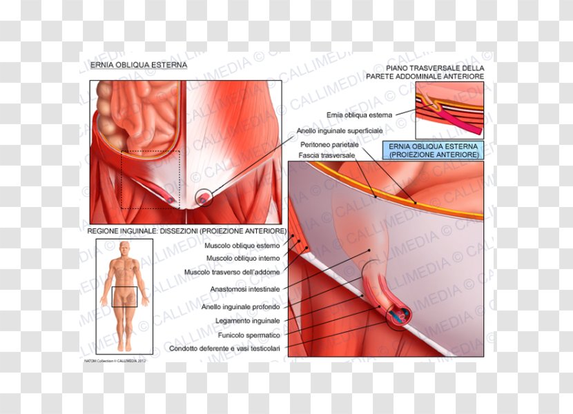 Inguinal Hernia Abdominal External Oblique Muscle Internal Groin - Cartoon Transparent PNG