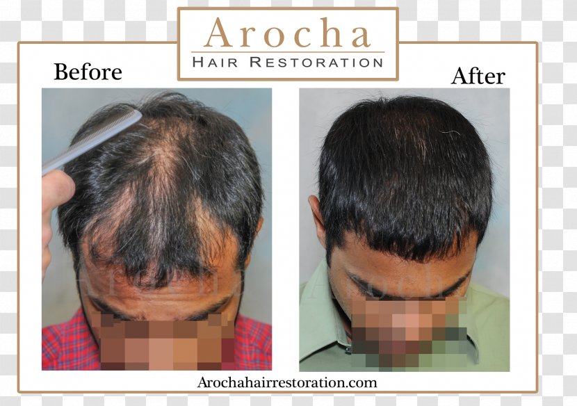 Forehead Hair Transplantation Graft Loss Follicular Unit Extraction - Ear Transparent PNG