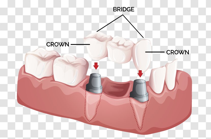 Bridge Crown Dentistry Dental Implant - Surgery - Postcard Transparent PNG