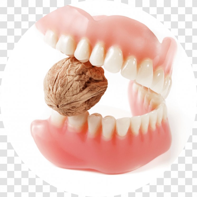 Prosthesis Tooth Bridge Royalty-free Dentures - Royaltyfree - Dental Restoration Transparent PNG